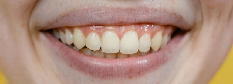 gelbe-zaehne-lachen